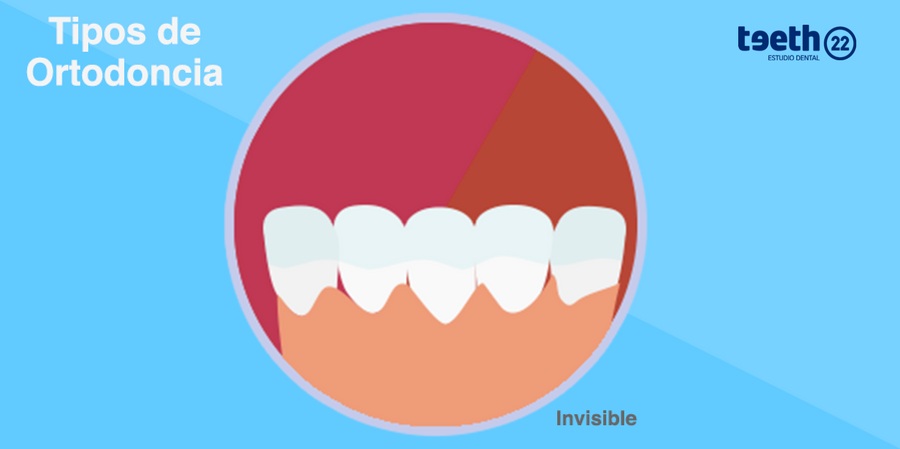 Tipos De Ortodoncia, ¿cuál Es La Mejor Opción? | Teeth 22