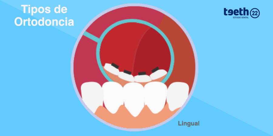 Tipos De Ortodoncia, ¿cuál Es La Mejor Opción? | Teeth 22