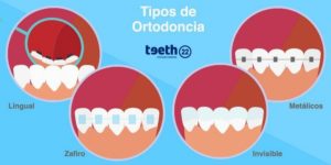 Tipos De Ortodoncia, ¿cuál Es La Mejor Opción? | Teeth 22