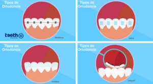 Tipos De Ortodoncia, ¿cuál Es La Mejor Opción? | Teeth 22