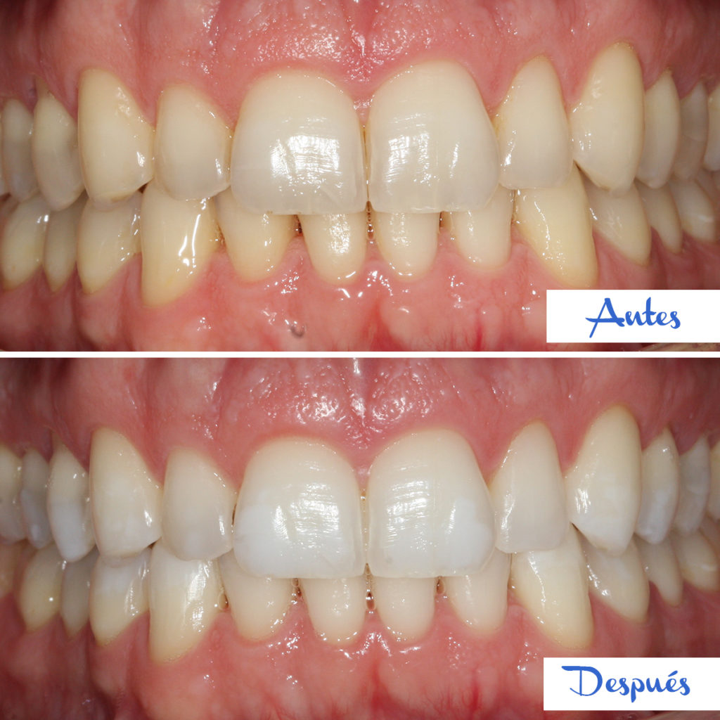 Resultados De Nuestro Blanqueamiento Dental | Teeth 22