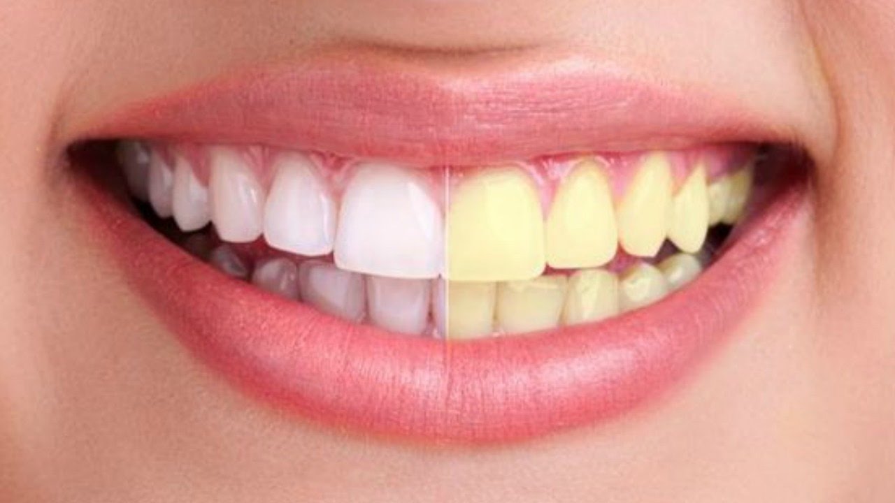 Blanqueamiento Dental: Antes Y Después | Teeth 22